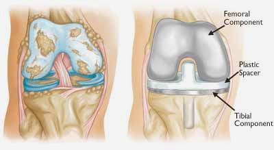 Total Knee Replacement